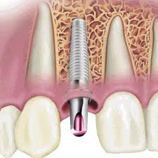 Silver Spring Dental Implants